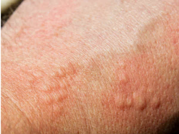 skin cancer skin cancer
