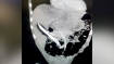 Rare surgery: 20-cm knife removed from 28-year-old man’s liver