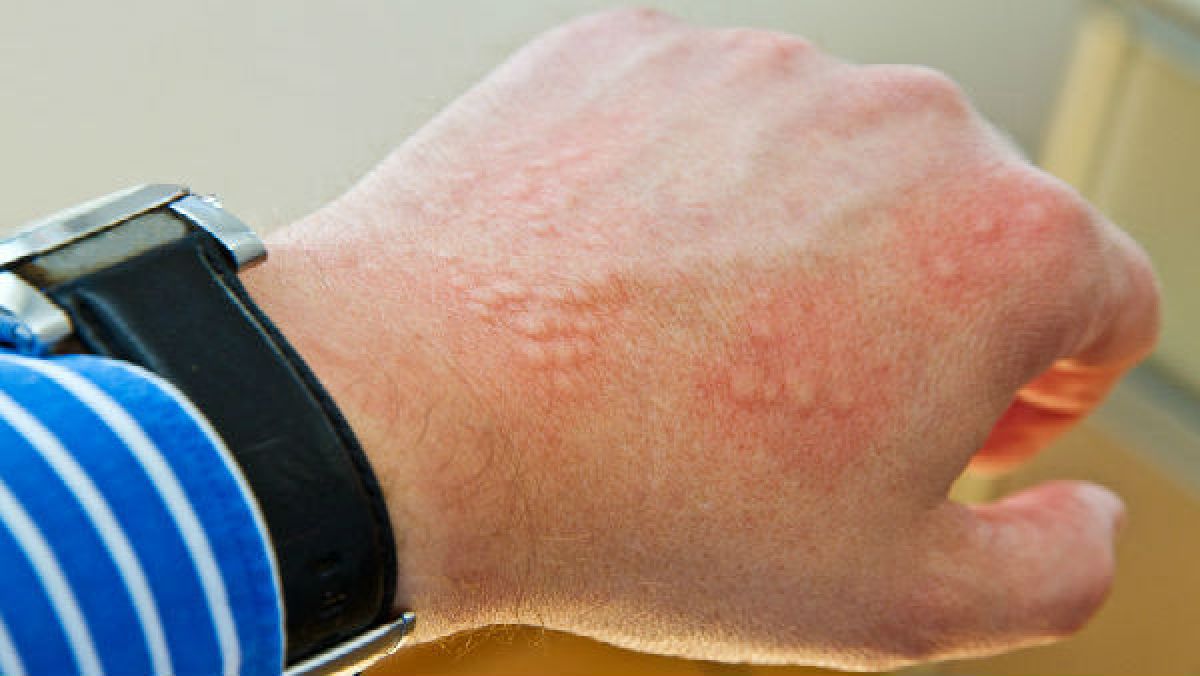 Study Claims Coronavirus Infection Linked With Skin Rashes Among Adults Oneindia News