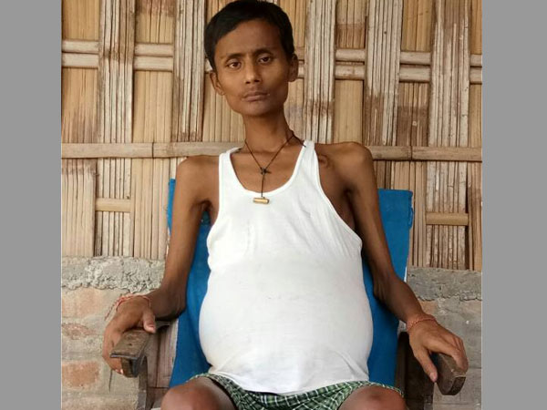 His dreams of playing football came dashing down: 21 year from Assam can't eat or sit today His dreams of playing football came dashing down: 21 year from Assam can't eat or sit today