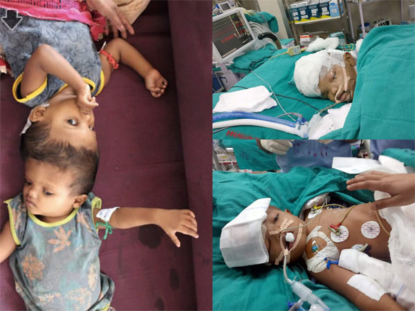 Conjoined twins from Odisha Jaga and Kalia (file picture at left), separated after 18 hours long surgery by a team of doctors at AIIMS in New Delhi Conjoined twins from Odisha Jaga and Kalia (file picture at left), separated after 18 hours long surgery by a team of doctors at AIIMS in New Delhi