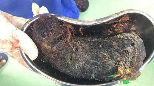 Half kg human hair, shampoo packets removed from 13-year-old girls stomach in Tamil Nadu Half kg human hair, shampoo packets removed from 13-year-old girls stomach in Tamil Nadu