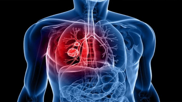 Lung Cancer