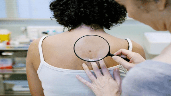 Skin cancer