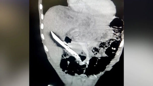 Rare surgery: AIIMS doctors remove 20-cm knife from 28-year-old man’s liver Rare surgery: AIIMS doctors remove 20-cm knife from 28-year-old man’s liver