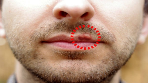 What are the skin problems developed post-Covid recovery? Doctors caution about Herpes, hair fall, nail issues What are the skin problems developed post-Covid recovery? Doctors caution about Herpes, hair fall, nail issues
