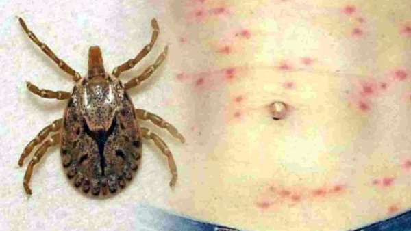 Viral fever in Firozabad: Central team says majority cases of dengue, a few of scrub typhus Viral fever in Firozabad: Central team says majority cases of dengue, a few of scrub typhus