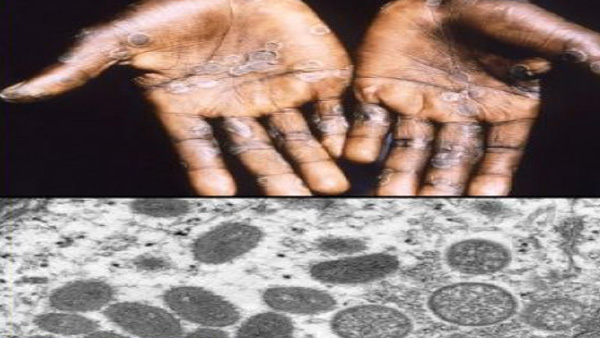 Monkeypox cases on rise: Why gay, bisexual men have been asked to stay on alert? Monkeypox cases on rise: Why gay, bisexual men have been asked to stay on alert?