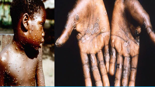 Explained: Are men who have sex with men at higher risk of catching monkeypox? Explained: Are men who have sex with men at higher risk of catching monkeypox?