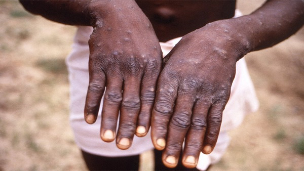 US confirms first case of Monkeypox: What is the virus and what are its symptoms US confirms first case of Monkeypox: What is the virus and what are its symptoms