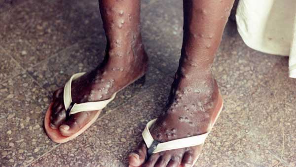 TN ups guard against Monkeypox TN ups guard against Monkeypox
