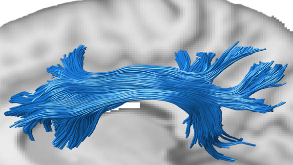 The image shows the superior longitudinal fasciculus (SLF), a white matter tract that connects the prefrontal and parietal cortex, two attention-related brain regions. The tract was estimated with diffusion MRI and tractography in the living human brain (Credits: Varsha Sreenivasan and Devarajan Sridharan) The image shows the superior longitudinal fasciculus (SLF), a white matter tract that connects the prefrontal and parietal cortex, two attention-related brain regions. The tract was estimated with diffusion MRI and tractography in the living human brain (Credits: Varsha Sreenivasan and Devarajan Sridharan)