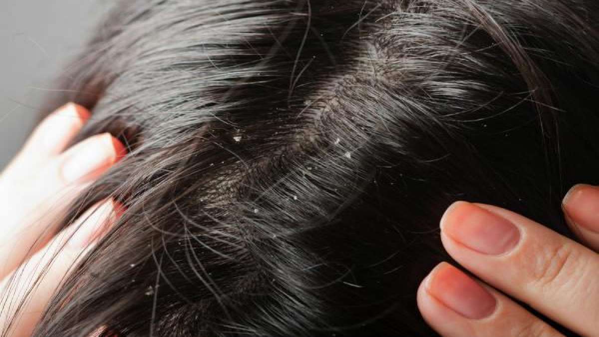 Hair Tips Just add this one thing along with henna dandruff will
